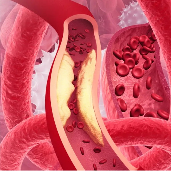 Can Calcium Supplements Lead to Vascular Calcification? How to Supplement Calcium Correctly